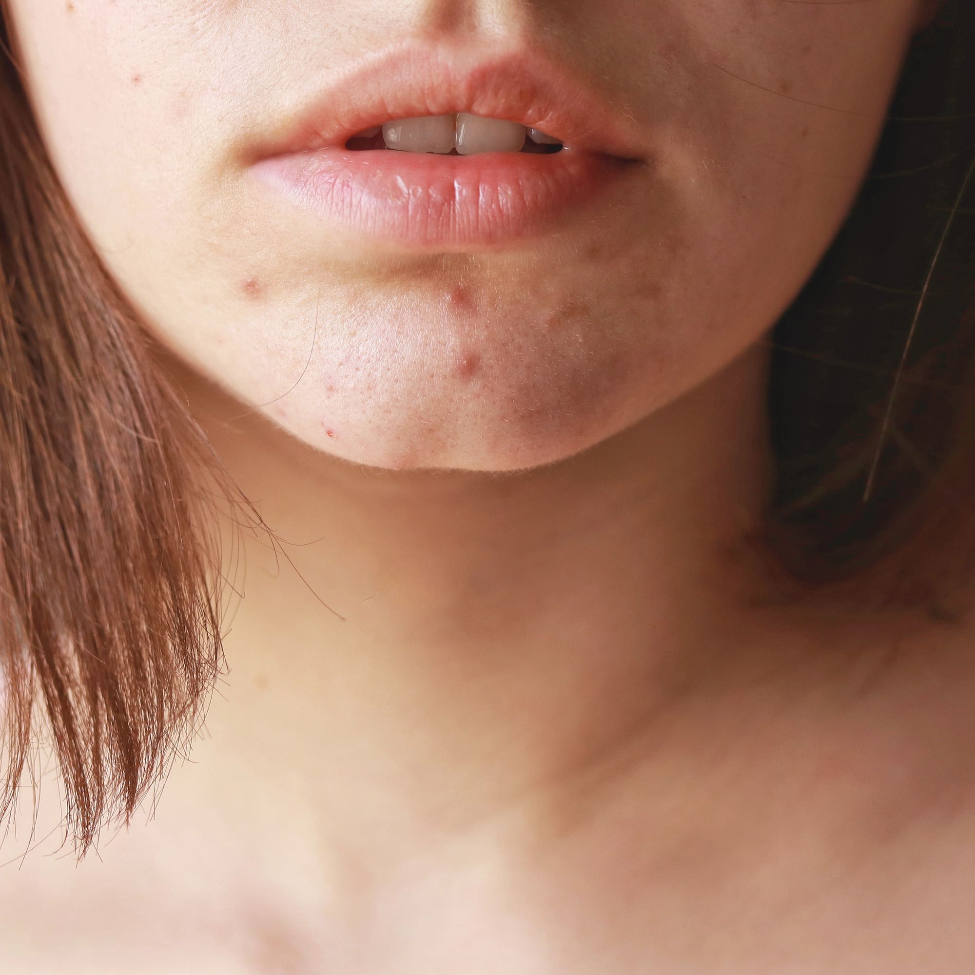 acne_femme_adulte_avene_sddm_mauritius