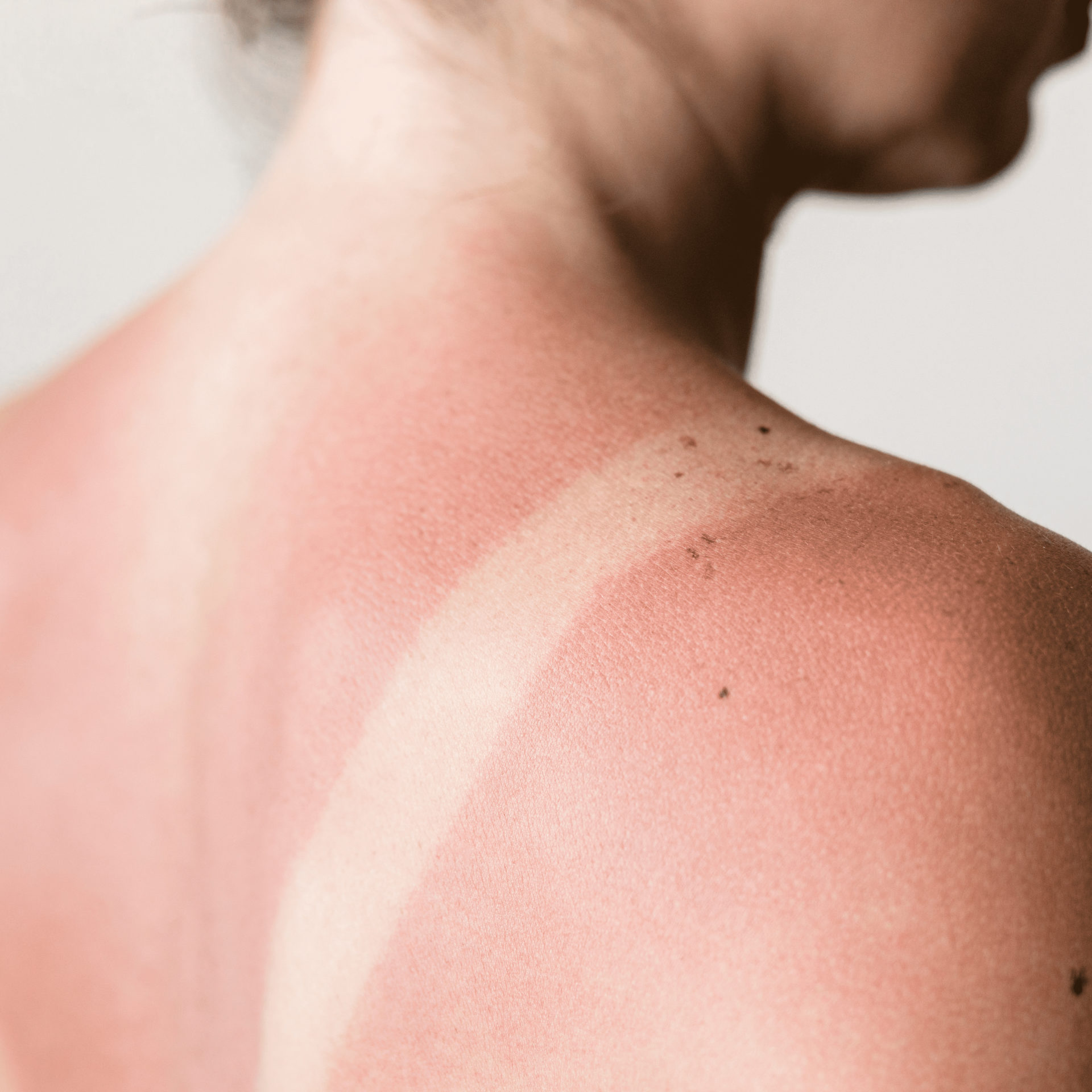 coups de soleil L’eczéma atopique est une inflammation chronique de la peau